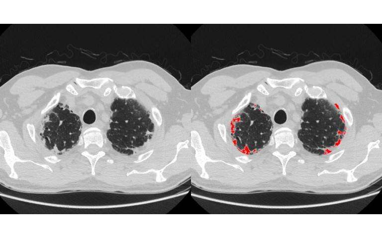 Η ηλεκτρονική ανάλυση εικόνας προσδιορίζει νέο υποτύπο εξουθενωτικής πνευμονικής νόσου