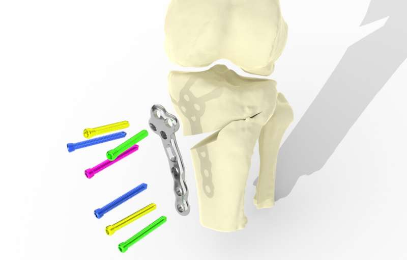 El implante de rodilla personalizado impreso en 3D podría ayudar a miles de personas con artritis